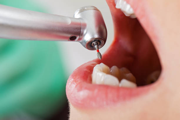 Best Emergency Wisdom Tooth Extraction in Lebanon South, PA